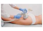 Best Cellulite Treatment San Diego Has to Offer