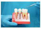 Why Choose Healing Abutments for Hex Implant Success