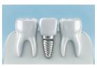 Dental Implant Research and Development for Better Care
