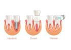 Get a Perfect Smile with Same-Day Crowns in Las Vegas!