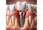 Explore Leading Conical Abutments Brands for Clinics