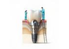 Affordable Abutment for Conical Implant Straight Fit