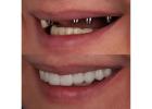 Explore Quality Dental Implant Components Wholesale