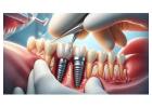 Dental Implant Products Wholesale: Quality You Can Trust