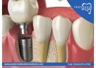 Say Goodbye to Cracked Teeth with Dental Restoration Near Me