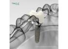 Best Dental Implant Brands in Venezuela | Trusted Sources
