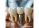 Leading Best Dental Implant Manufacturers in Honduras