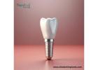Discover Dental Implant Manufacturers in Paraguay Today