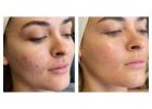 Laser Skin Resurfacing Clermont