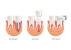 Get a Perfect Smile with Same-Day Crowns in Las Vegas!