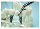 Leading Dental Implant Products Wholesale for Your Needs