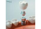 Dental Implant OEM Suppliers in Honduras for Accuracy