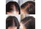 Scalp Micropigmentation: Game Changer for Thinning Hair