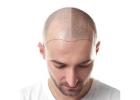 hair transplant in pakistan