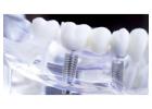 Affordable Dental Implants – Restore Your Smile Today!