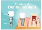 Affordable Dental Implants – Restore Your Confident Smile