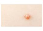 Genital Warts Removal London – Discreet Care at London Dermatology Clinics