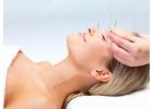 Acupuncture Treatment in Toronto: Personalized Care for Natural Healing