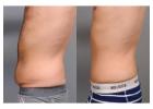 Get Rid of Belly Fat with Liposuction in Islamabad
