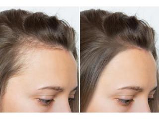 Scalp Micropigmentation: Natural-Looking Solution for Hairline Confidence Scalp Micropigmentation: Natural-Looking Solution for Hairline Confidence