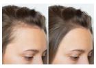 Scalp Micropigmentation: Natural-Looking Solution for Hairline Confidence