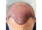 FUT Hair Transplant in Islamabad