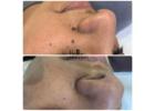 Laser removal of skin tag