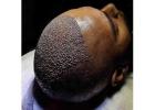 FUE Hair Transplant in Islamabad