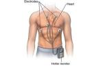 Cardiac Holter Monitor Mississauga - Reflex Medical Center
