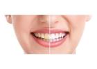 Professional Teeth Whitening Philly Services Helping Patients Achieve Brighter Confident Smiles
