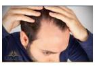 Hair Restoration in Torrance: Advanced Solutions for Thinning Hair and Lasting Results