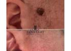 Laser removal of skin tag