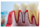 Restore Your Smile with Advanced Dental Implants in Pickering
