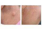 Same Day Cyst Removal – Fast and Safe Treatment in London