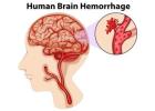 Best Brain Hemorrhage Treatment With Neurology Experts