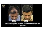 What Is Hair Transplant? Get Natural Results at MedLinks