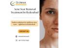 Acne Scar Removal Treatment In Hyderabad | Dr. Venus
