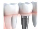 Dental Implant Surgery with Safe and Professional Care