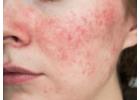 Targeted and Effective Face Spot Treatment – Clearer Skin Starts Here