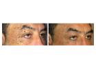 Expert Guide on How to Remove a Skin Tag from Eyelid Safely and Effectively