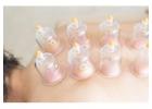 Cupping Therapy NYC | Expert Cupping Services in New York City