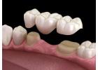 Dental Fillings in Abbotsford | Restore Your Smile