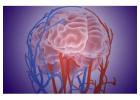 Stenting Renal Artery Treatment for Better Blood Flow