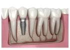 Finding the Right Dentist Near Me in Abbotsford