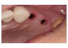 Full Mouth Dental Implants in Mexico with Teeth Savers